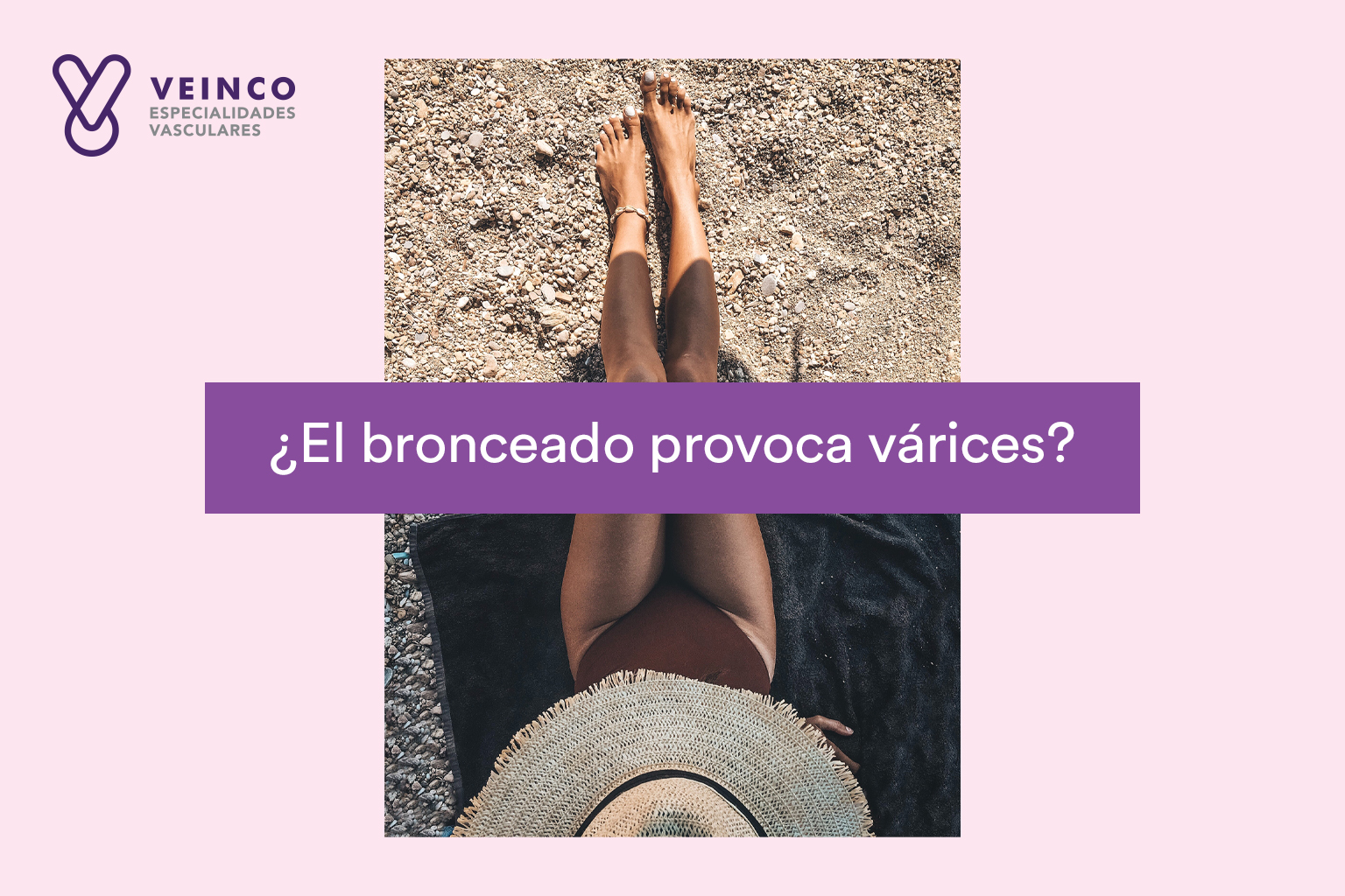 ¿Tu bronceado podría estar provocándote várices?