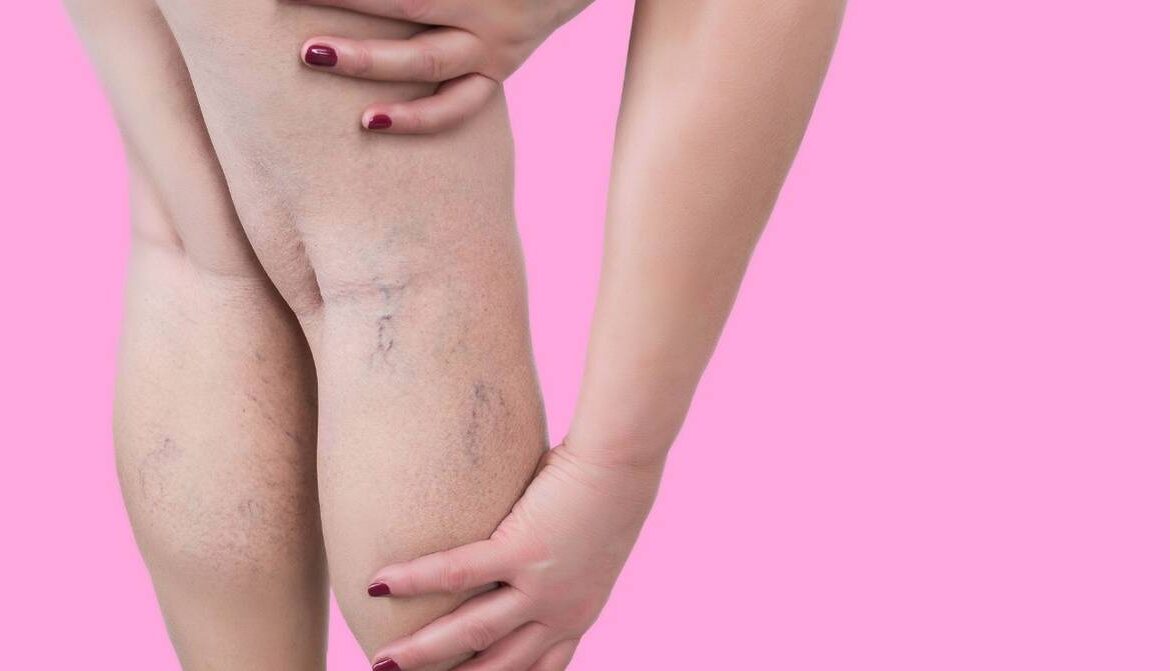 woman touching her legs with chronic venous insufficiency