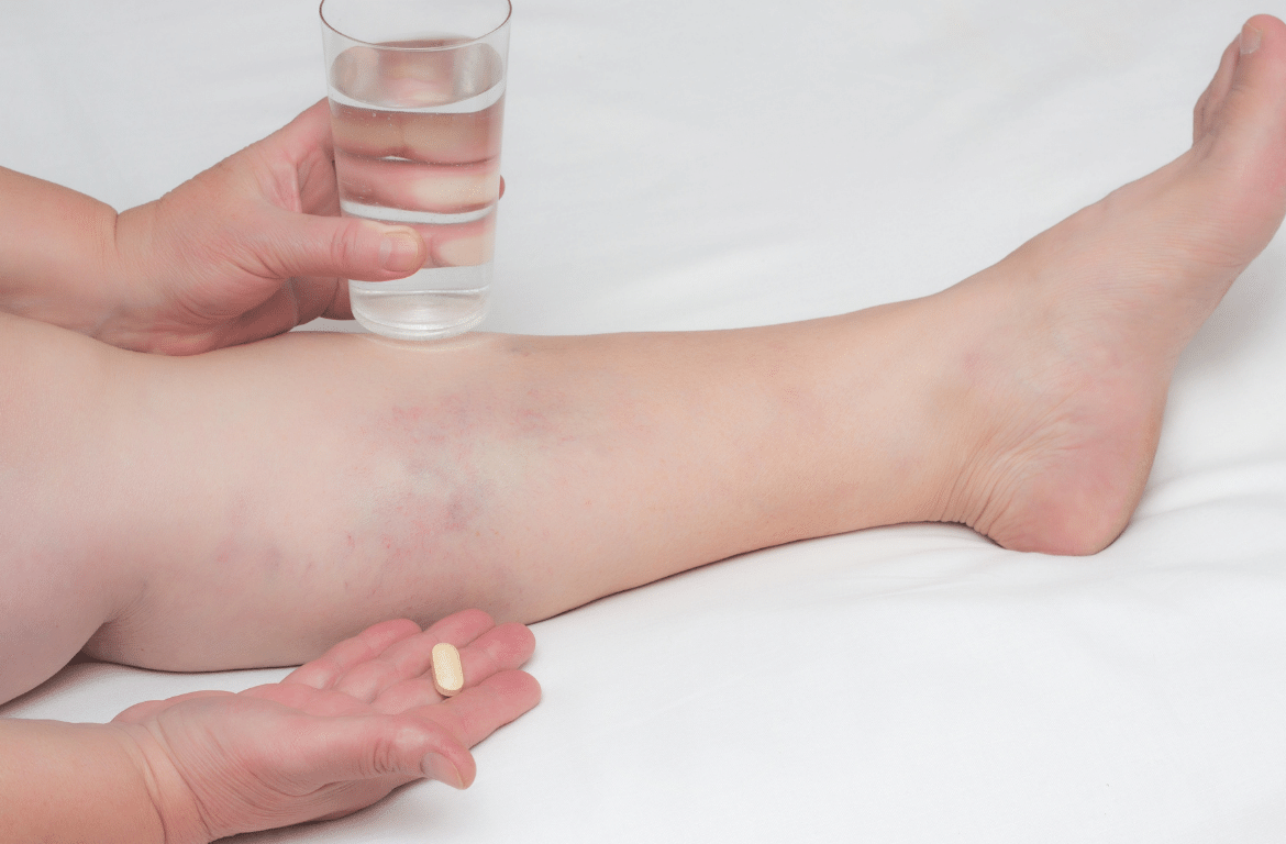 legs in chronic venous insufficiency treatment