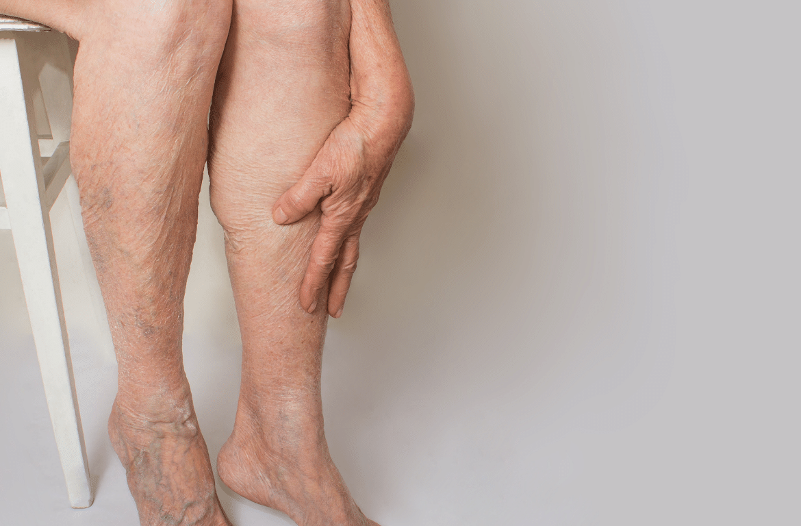 legs in one of the chronic venous insufficiency stages