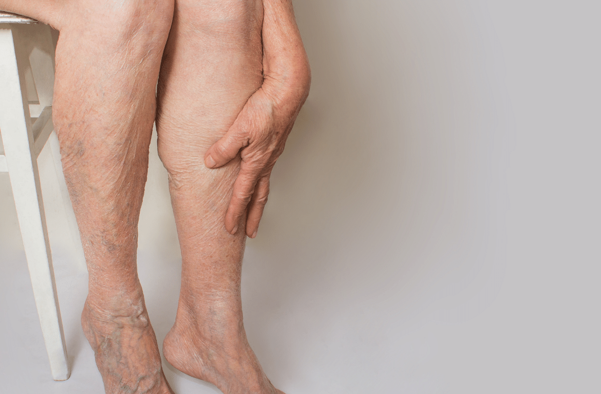 Venous Insufficiency