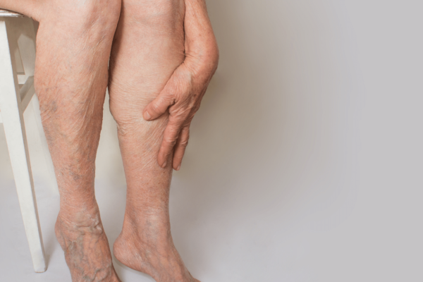legs in one of the chronic venous insufficiency stages