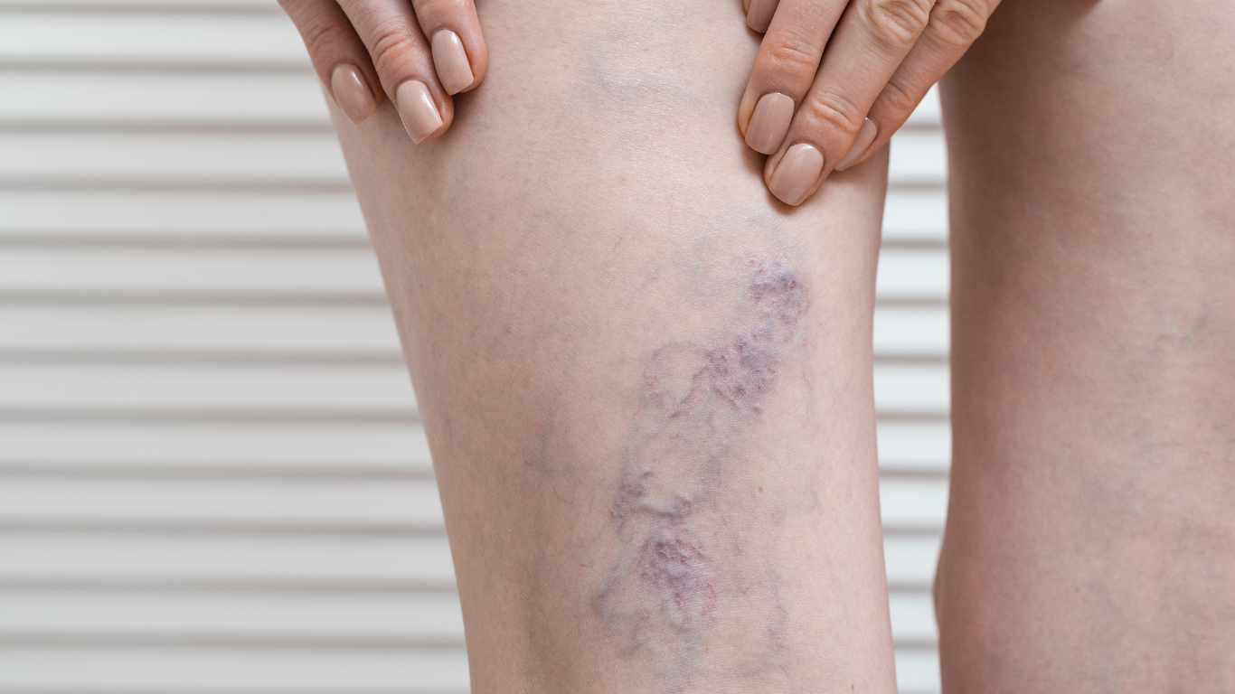 How to Treat Varicose Veins – Minimally Invasive Treatment