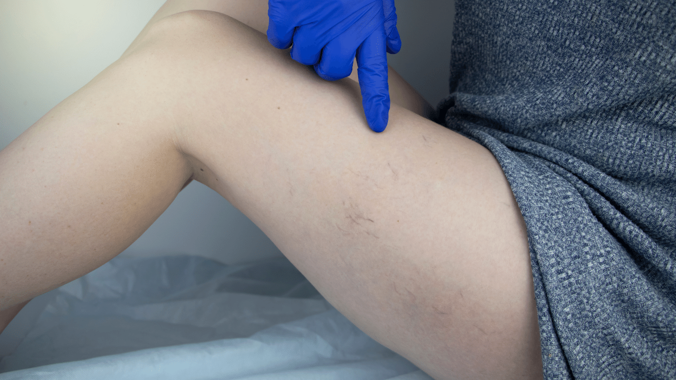 Spider Veins – Remove Them Successfully with Sclerotherapy