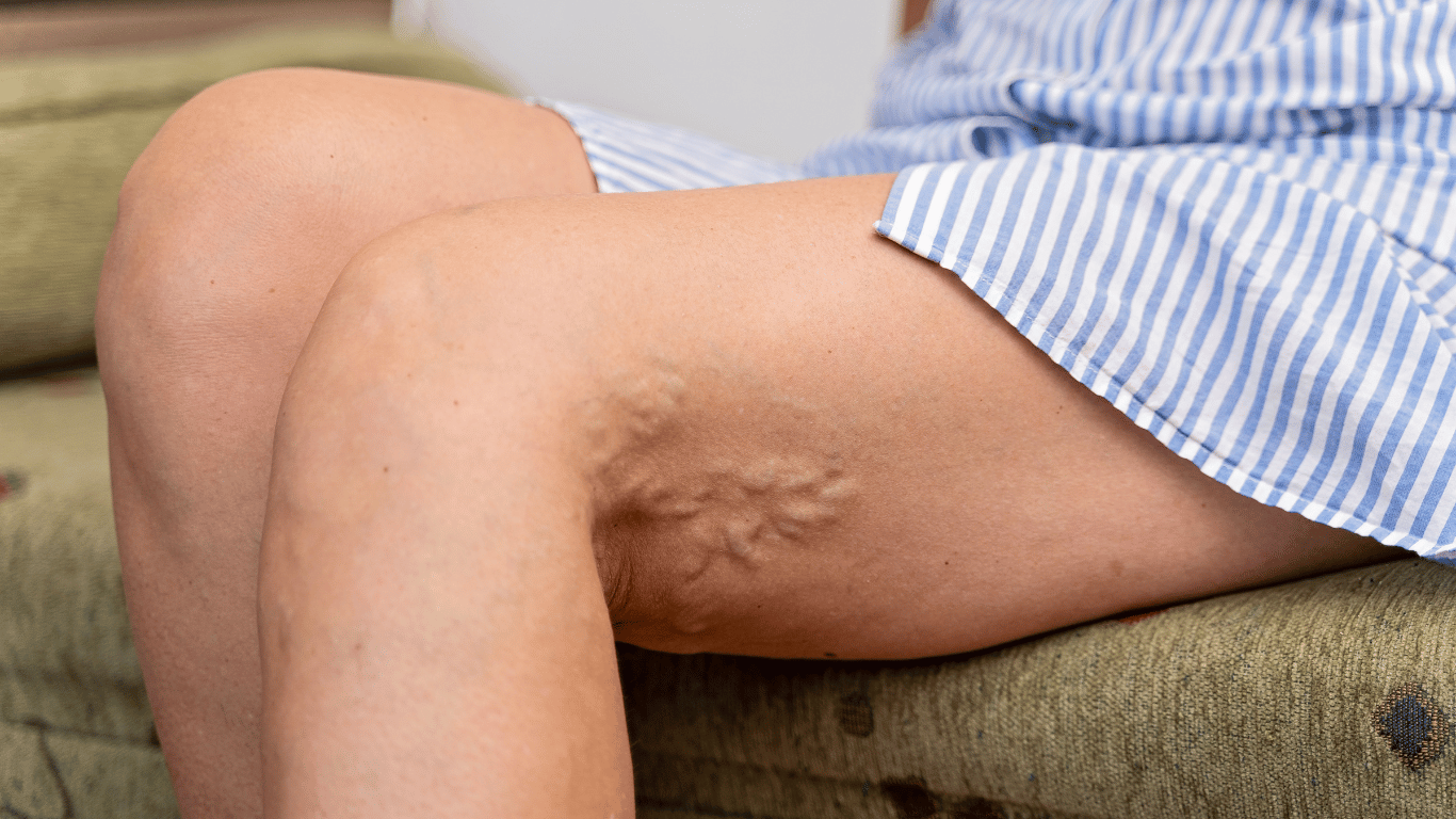 Bulging Veins in Legs: Symptoms and Causes