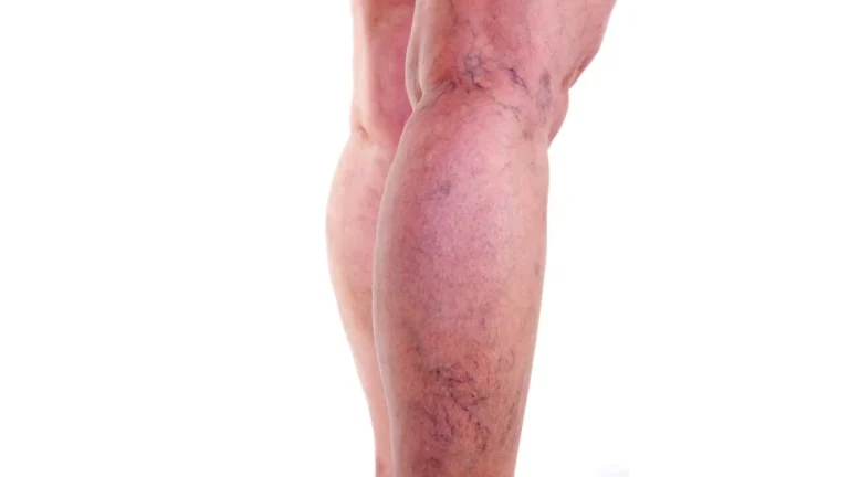 Trombosis venosa profunda: Síntomas que exigen atención