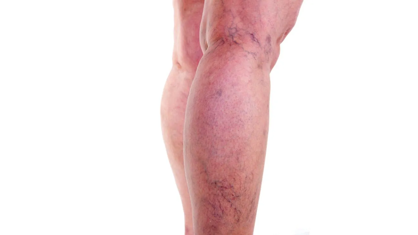 Trombosis venosa profunda: Síntomas que exigen atención