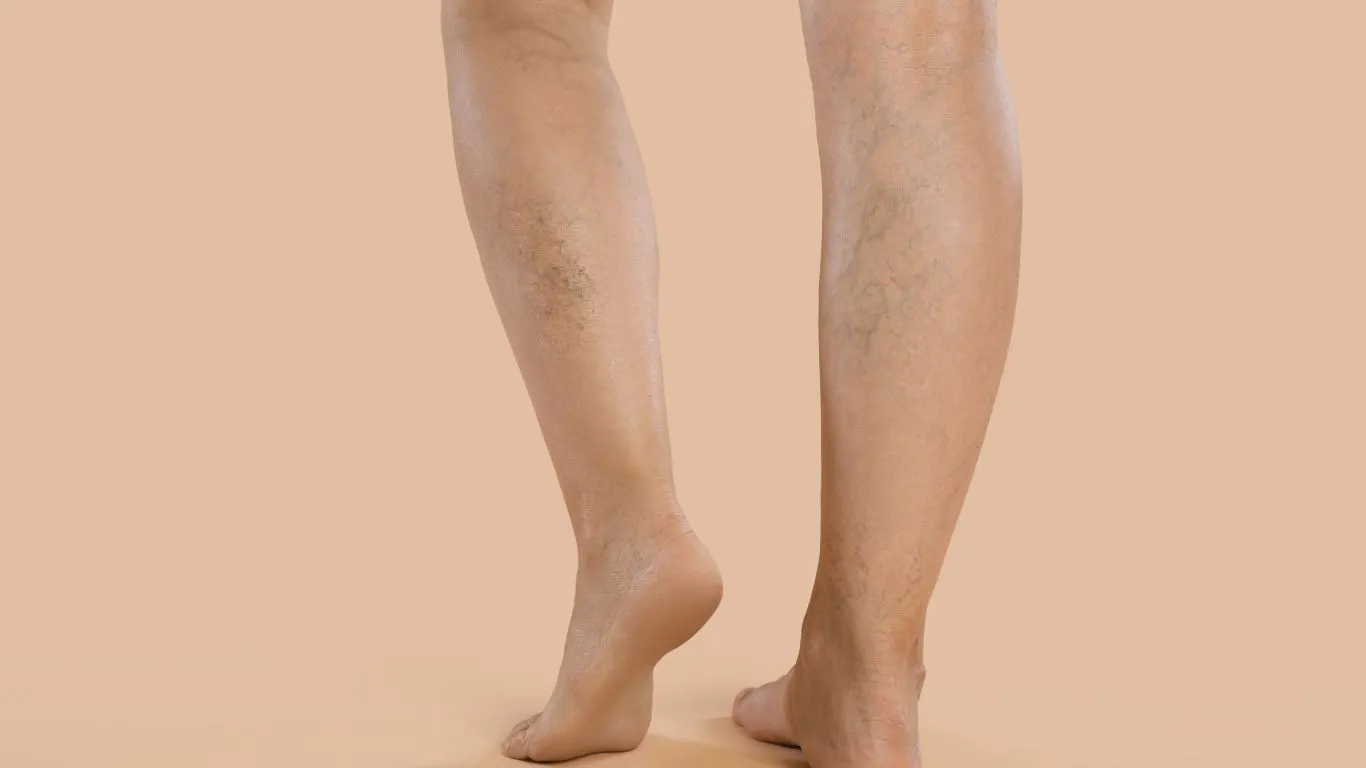 Várices por estar de pie: Causas y cómo eliminarlas