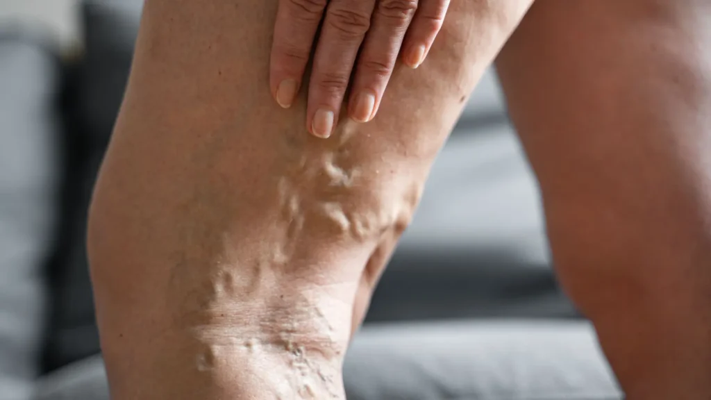 Persona tocando una pierna con venas varicosas prominentes y venas inflamadas visibles alrededor de la rodilla.